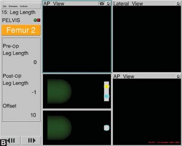 Illustration 12 for Avoiding Errors: Navigation in Total Hip Arthroplasty