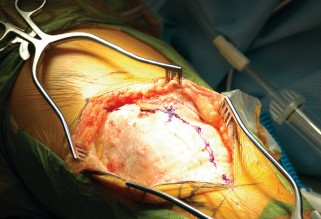 Illustration 11 for Optimize Tibial Component Alignment: Techniques for TKA Success
