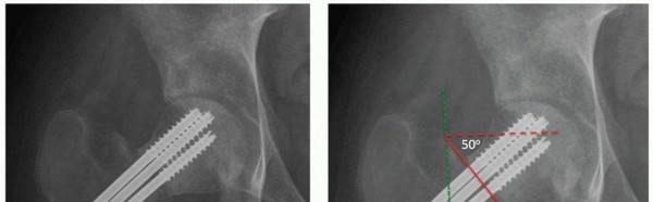 صورة طبية: جراحة قطع العظم حول الحُق وقطع عظم الفخذ: إعادة محاذاة مفصل الورك لراحة دائمة مع الأستاذ الدكتور محمد هطيف