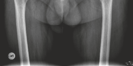 Illustration 3 for Advanced Bilateral Simultaneous THA: Uncemented Monobloc Case Title