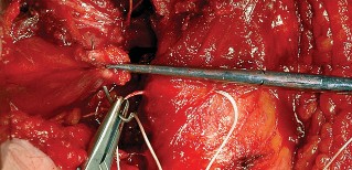 Illustration 71 for Unlock the Figure Posterior Approach to the Hip