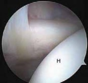 Illustration 11 for Arthroscopic Subscapularis Repair: The lo iky brady Method for Stability