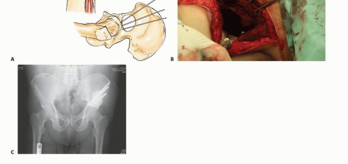 Illustration 43 for Pelvic Metastasis Surgery: A Component of the Utilitarian Approach