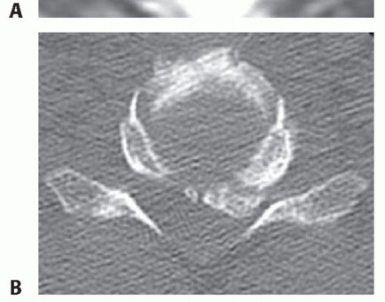 Illustration 7 for How ACDF Clears Your Posterior Disc Space for Lasting Relief