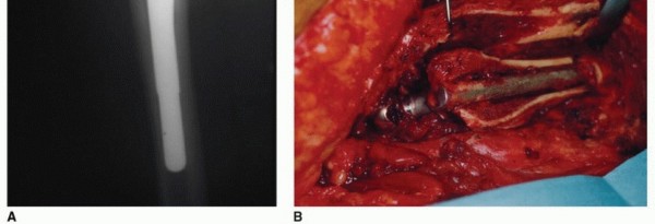 infection arthroplasty