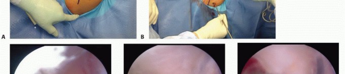 Arthroscopic Release of Nerve: Find Lasting Relief from Entrapment