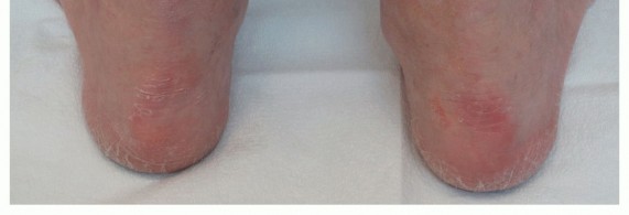 Illustration 2 for Lateral Column Lengthening: Relieve Flatfoot Pain & Correct Deformity