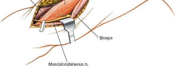 Illustration 62 for Mastering the Approach to the Distal Humerus: Safety & Skills