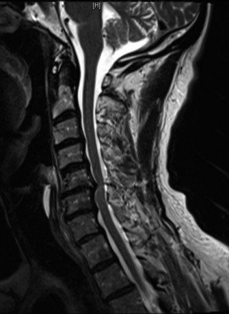 Illustration 11 for Adjacent Segment Degeneration: Your Next Spine Case Solved