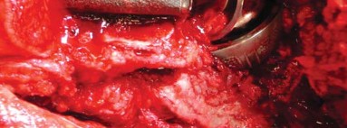 Illustration 19 for Management of Periprosthetic Fractures: An Expert Surgical Guide