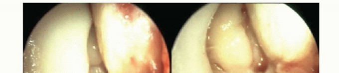 Illustration 15 for Medial Ankle Instability: Find Relief with Reconstruction