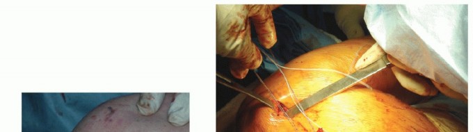 Illustration 18 for End CN XI Palsy Pain: The Eden-Lange Procedure Solution