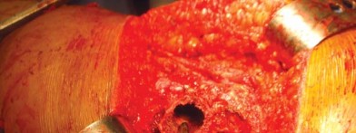 Illustration 58 for The Silent Hip: Achieving a Truly Silent, Pain-Free Joint