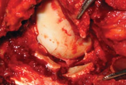 Illustration 4 for Navigating Early THA for Fractures of the Acetabulum
