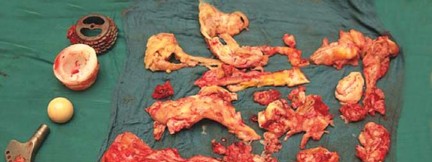 Illustration 42 for Optimizing Infected THA: The One Staged Approach Explained