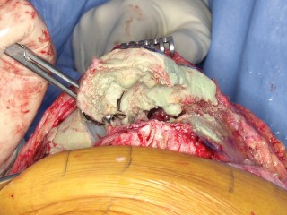 Illustration 41 for PROSTALAC Articulating Spacer: Treat Infected Knees, Regain Mobility