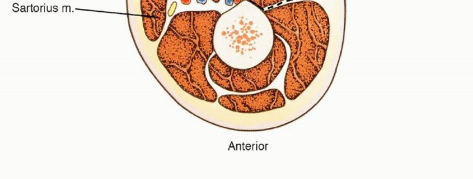 Illustration 3 for Posterior Thigh Resection: Rethinking Outcomes & Limb Sparing