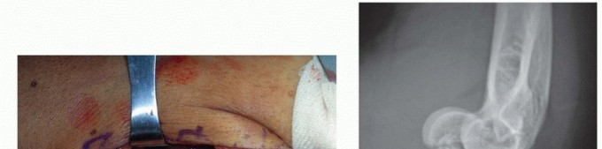 Illustration 6 for Navigating Capitellum and Capitellar-Trochlear Shear Fracture Repair