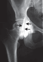 Illustration 7 for J. W. Thomas on Snapping Hip: Causes, Cures & Relief