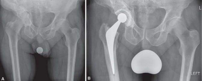 Illustration 8 for Navigating Early THA for Fractures of the Acetabulum