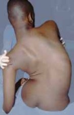 Illustration 2 for Optimizing Instrumentation for Neuromuscular Scoliosis