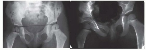 Illustration 12 for Treatment for Congenital Femoral Deficiency: What You Need to Know