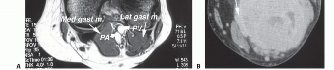 Illustration 2 for Complex Popliteal Resections: Protecting the Greater Saphenous Vein
