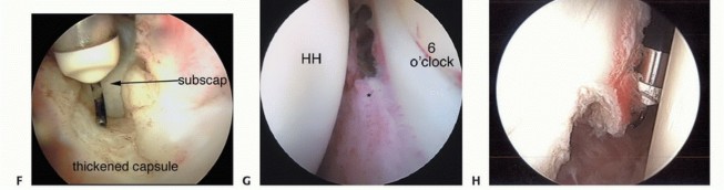 Illustration 15 for Stiff Shoulder? Discover Arthroscopic Capsular Release Solutions