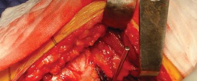 Illustration 4 for Posterolateral Surgical Approaches: Achieve Optimal Hip Replacement