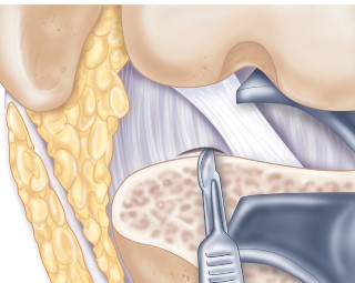Illustration 35 for Precision Soft Tissue Balancing in Revision: Avoid TKA Pitfalls