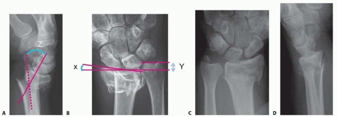 Illustration 5 for Distal Radius Fixation: Precision Through Lister's Tubercle