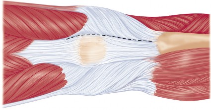 صورة طبية: استبدال مفصل الركبة بالحد الأدنى من التدخل الجراحي: ألم أقل وتعافٍ أسرع مع النهج شبه الرضفي الإنسي