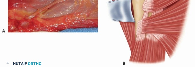 Illustration 5 for Irreparable Subscapularis Tears? Explore Pectoralis Major Transfer.