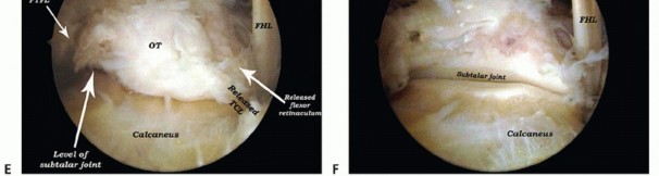Illustration 20 for Posterior Talar Process: Endoscopic Solutions for Ankle Pain