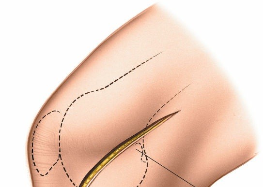 Illustration 65 for Mastering Knee Approaches: Spotlight on Superficial Medial Ligament