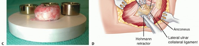 Illustration 18 for Radial Head Arthroplasty: Restoring Elbow Function & Stability