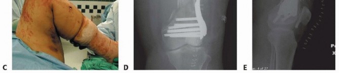 Illustration 64 for Repairing Distal Femur Fractures: Open Reduction & Internal Fixation