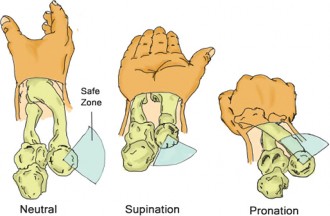Illustration 4 for Radial Head Fracture: Symptoms, Diagnosis, and Surgical Indications