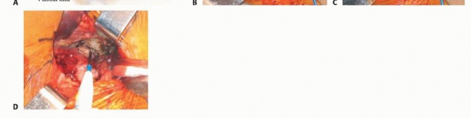 Illustration 28 for Hemiarthroplasty of the Hip: Indications & Types Explained