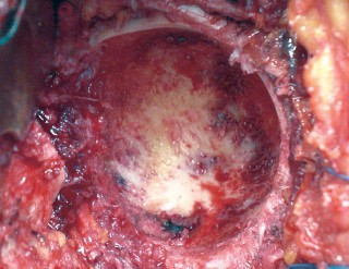 Illustration 32 for Mastering the Cementless Acetabular Cup: Techniques for Optimal Fixation
