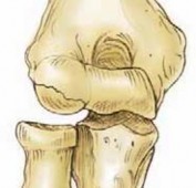 Illustration 42 for Precision Arthroscopy for Chondral Injuries & OCD: Direct Lateral Portal