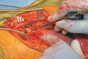 Illustration 36 for Mastering Anterior Interbody Arthrodesis with Instrumentation for Scoliosis