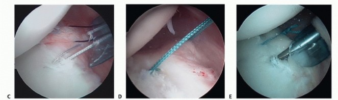 Illustration 8 for Mastering the Treatment of Recurrent Posterior Shoulder Instability