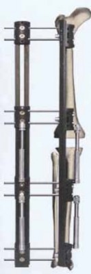 Illustration 5 for Knee Arthrodesis: A Lifelong Knee Solution for Trauma & TKA