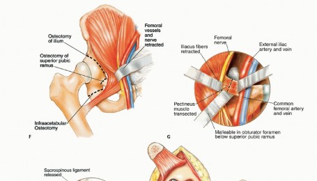 Illustration 31 for Surgical Pelvic Resection: Gluteus Maximus Muscle & Nerve Preservation