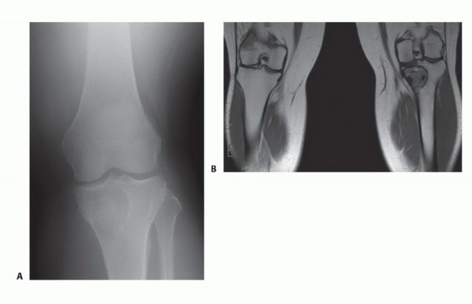 Avoid Major Surgery: Bone Tumor Treatment with Liquid Nitrogen Pour
