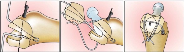 Illustration 5 for Standard Trochanteric Osteotomy: Key to Complex Hip Cases