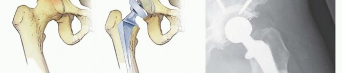 Illustration 2 for Regain Mobility: Total Hip Arthroplasty for Malignant Lesions
