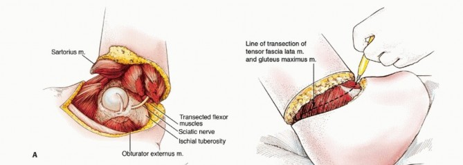 Illustration 14 for Mastering Hip Disarticulation: Through the Hip Joint Capsule