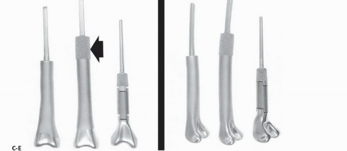 Illustration 7 for Distal Femoral Replacement: Key to Modern Limb Salvage